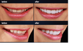 Best Cosmetic Dentistry Services | All On 4 IMPLANTS |Bristol CT